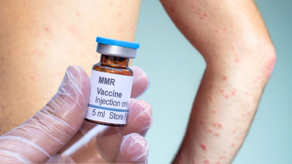 El brote de sarampión en México es un reflejo del abandono de la prevención sanitaria básica.