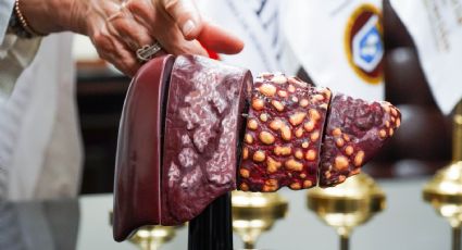 HU de la UANL intensifica acciones para combatir las hepatitis virales