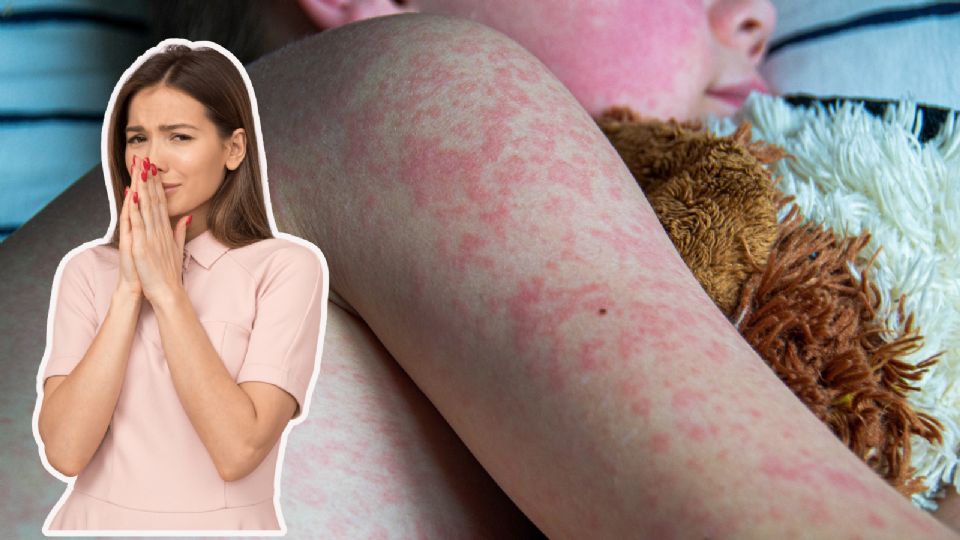 El sarampión es una enfermedad viral altamente contagiosa que puede ocasionar complicaciones severas como neumonía o daño cerebral.