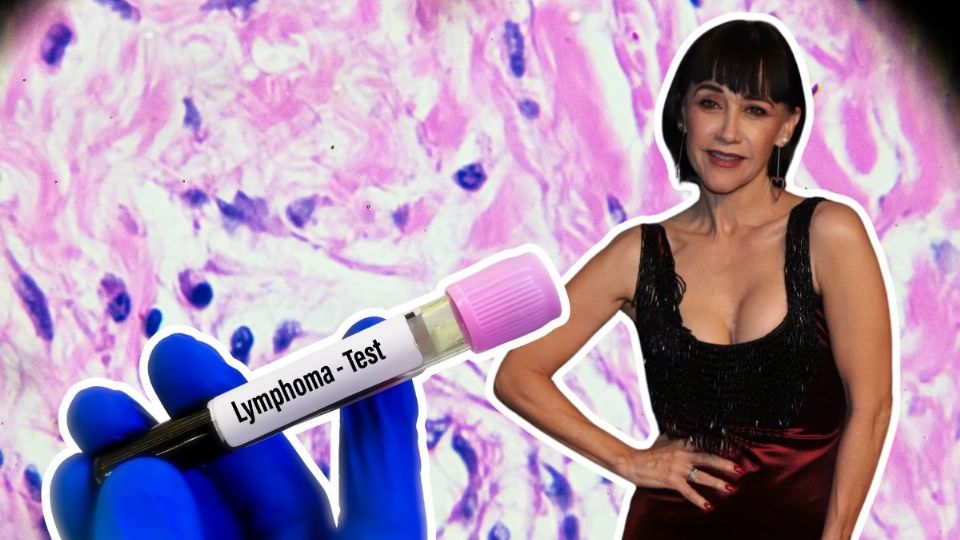 ¿Qué es el linfoma de Hodgkin? Esto se sabe sobre el cáncer diagnosticado a Susana Zabaleta