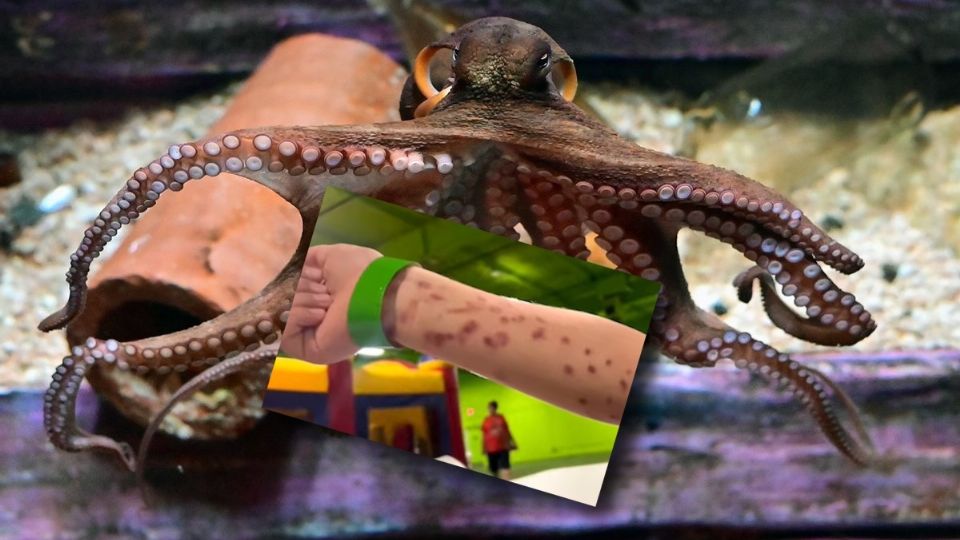 Niño de apenas 6 años fue atacvado por un pulpo en San Antonio, Texas, y así quedó su brazo.
