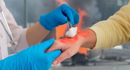 Explosión de pipa en Zaragoza: ¿qué hacer si un niño sufre quemaduras de segundo grado?