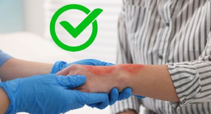 ¿Qué hacer en caso de sufrir quemaduras de segundo grado en el cuerpo?