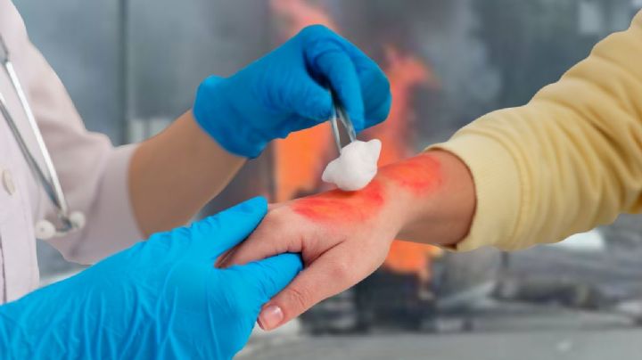 Explosión de pipa en Zaragoza: ¿qué hacer si un niño sufre quemaduras de segundo grado?