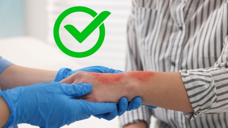 ¿Qué hacer en caso de sufrir quemaduras de segundo grado en el cuerpo?