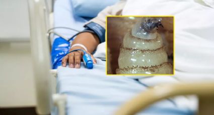 Miasis en México: dos personas más fallecen por casos de esta larva