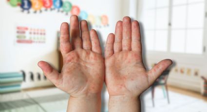 Cierran jardín de niños en Tulum por brote de coxsackie; ¿qué es y cómo protegerse?