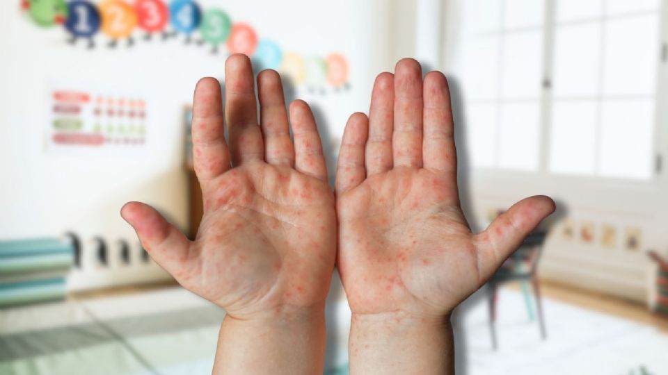 De acuerdo con los reportes oficiales, ninguno de los casos ha presentado complicaciones graves.