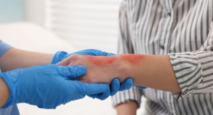 Anuncia DIF Nuevo León cirugías gratis para menores con quemaduras