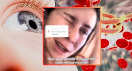 Influencer pierde la visión de un ojo tras infección por parásito; alerta sobre el uso de lentes de contacto