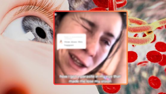 Influencer pierde la visión de un ojo tras infección por parásito; alerta sobre el uso de lentes de contacto