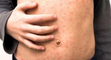 México analizará medidas contra el sarampión rumbo al Mundial 2026: Salud