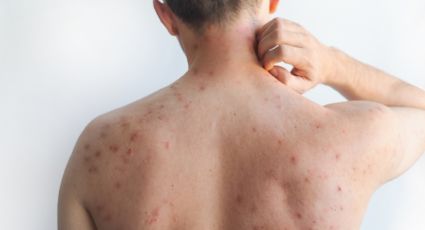 Confirman tercer caso de sarampión en Nuevo León en lo que va del año