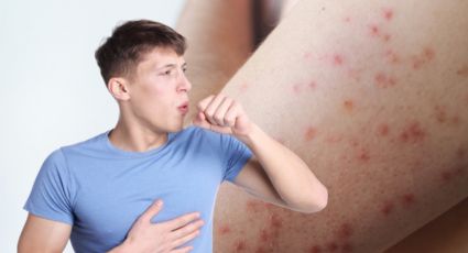 Sarampión en Nuevo León: señales de alerta y síntomas de contagio