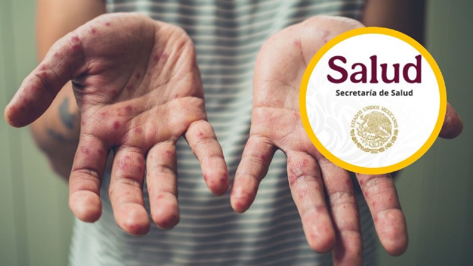 Una sola persona infectada puede transmitir la enfermedad hasta a 18 personas no vacunadas.