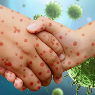 Sarampión en la capital: Secretaría de Salud confirma muerte en la CDMX