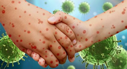 Sarampión en la capital: Secretaría de Salud confirma muerte en la CDMX