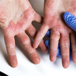 Dermatitis atópica: el padecimiento invisible que deteriora la calidad de vida
