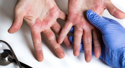 Dermatitis atópica: el padecimiento invisible que deteriora la calidad de vida