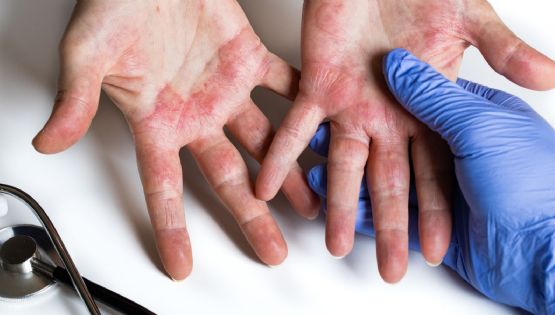 Dermatitis atópica: el padecimiento invisible que deteriora la calidad de vida