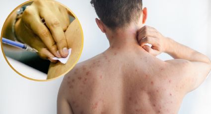 ¿Adultos deben vacunarse contra el sarampión? Autoridades aclaran ante brote en México