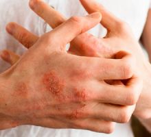 Dermatitis atópica: claves para prevenir brotes y proteger tu piel