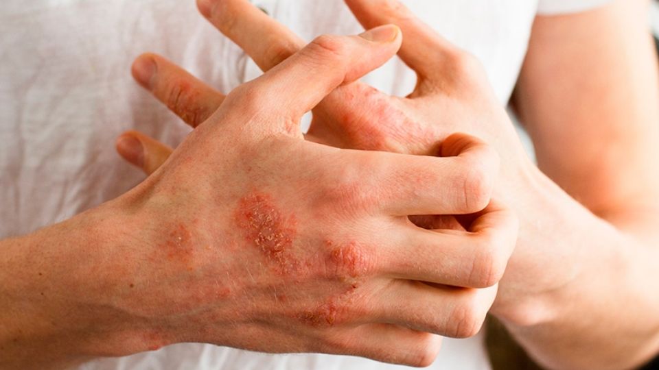 El impacto real: cuando la dermatitis atópica deja huella en la vida diaria.