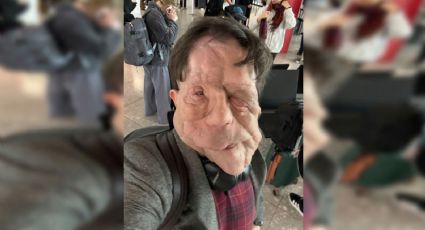 Adam Pearson visibiliza la neurofibromatosis tipo 1 en los premios Oscar