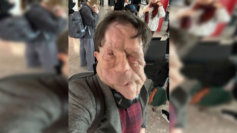 El actor británico Adam Pearson, diagnosticado con este raro trastorno genético cutáneo, posa de manera resiliente durante la reciente entrega de los premios Oscar 2026.