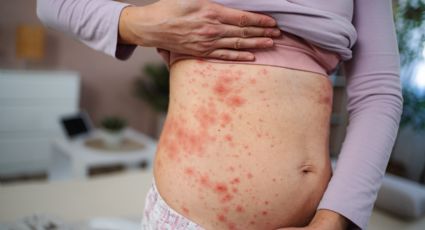 Llega Nuevo León a 50 casos de Sarampión; reporta dos nuevos casos