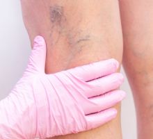 Adiós a las várices: tratamientos sin cirugía que alivian dolor y mejoran tu calidad de vida