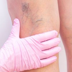 Adiós a las várices: tratamientos sin cirugía que alivian dolor y mejoran tu calidad de vida