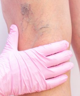 Adiós a las várices: tratamientos sin cirugía que alivian dolor y mejoran tu calidad de vida