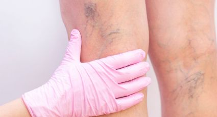 Adiós a las várices: tratamientos sin cirugía que alivian dolor y mejoran tu calidad de vida