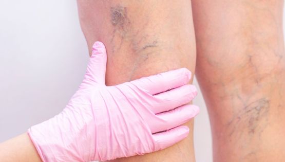 Adiós a las várices: tratamientos sin cirugía que alivian dolor y mejoran tu calidad de vida