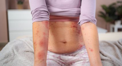 Llega Nuevo León a 52 casos de Sarampión; reporta tres nuevos casos